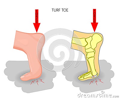 Turf toe. Rupture of the plantar plate of the first toe of the f Cartoon Illustration