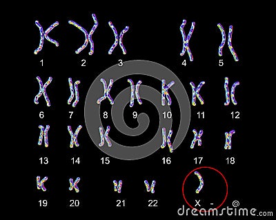 Turner s-syndrome karyotype Cartoon Illustration