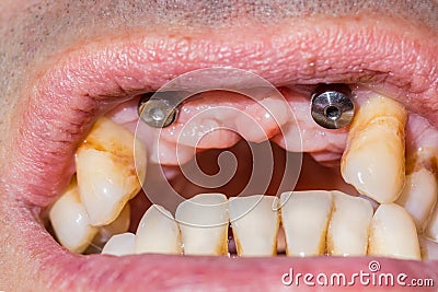 Two canine dental implants in the mouth of a patient with advanced periodontitis Stock Photo