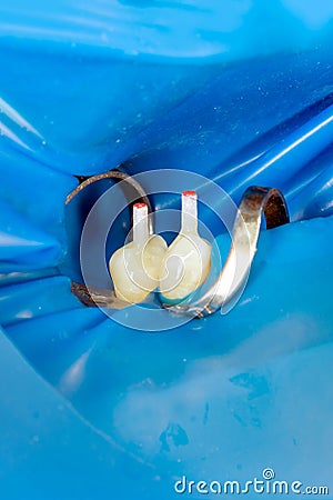 Two chewing side teeth of the upper jaw after treatment of caries. Restoration of the chewing surface with a photopolymer filling Stock Photo