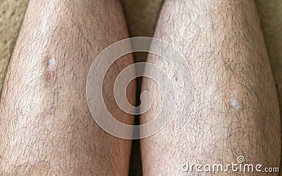 Two large gash wounds healing naturally on the lower leg Stock Photo