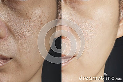 Two pictures compare effect Before and After treatment. skin with problems of freckles , pore , dull skin and wrinkles Stock Photo