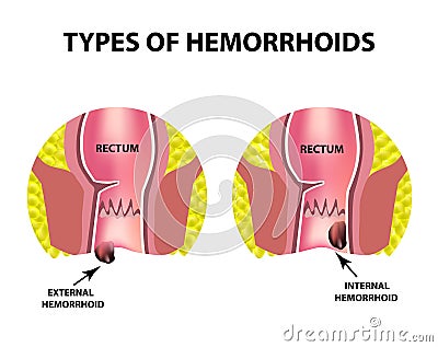 Two types of hemorrhoids are external and internal. Rectum structure. Intestines. colon. Internal and external hemorrhoidal node. Vector Illustration