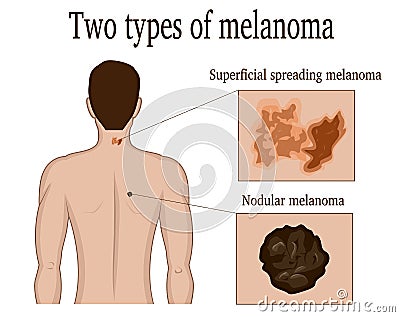 Two types of melanoma Vector Illustration