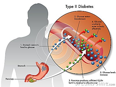 Type 2 diabetes Vector Illustration