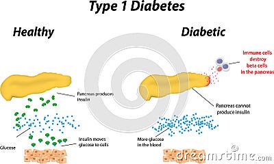 Type 1 Diabetes Vector Illustration