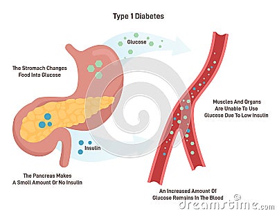 Type 1 diabetes. Juvenile diabetes or insulin-dependent diabetes. Vector Illustration