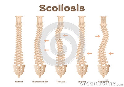 Type, scoliosis medical anatomical / backbone / organ Vector Illustration