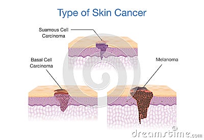 Type of Skin Cancer in 3D vector style. Vector Illustration