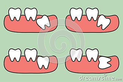 Type of wisdom tooth affect to other teeth Vector Illustration