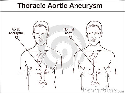 Types of abdominal aortic aneurysm. normal aorta and enlarged vessels. Vector diagram Vector Illustration