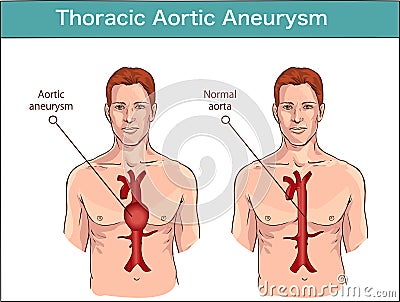 Types of abdominal aortic aneurysm. normal aorta and enlarged vessels. Vector diagram Vector Illustration