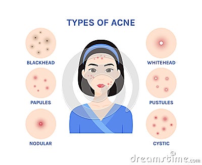 Types of acne. Beautiful Asian Woman with Problem Skin on her Cute Face. Acne treatment. Flat color cartoon style. White Vector Illustration