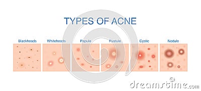 Types of Acne diagram for skin problems content. Vector Illustration