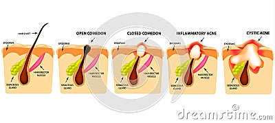 Types of acne. Open comedones, closed comedones, inflammatory acne, cystic acne. The structure of the skin. Infographics. Vector Vector Illustration