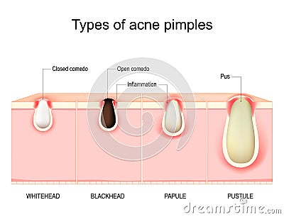 Types of acne pimples. Cross section of human Skin Vector Illustration