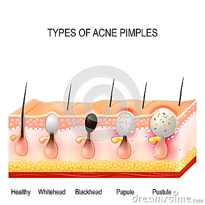 Types of acne pimples Vector Illustration