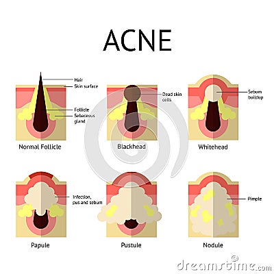 Types of acne pimples. Healthy skin, Whiteheads and Blackheads, Papules and Pustules in flat style. Stock Photo