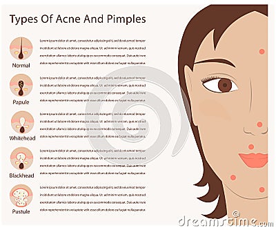 Types of acne and pimples Vector Illustration