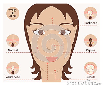 Types of acne and pimples Vector Illustration