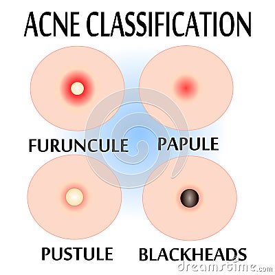 Types of Acne and Pimples, Vector Illustration