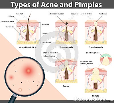 Types of Acne and Pimples, vector illustration Vector Illustration