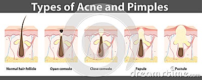Types of acne, structure of pimple, vector illustration Vector Illustration