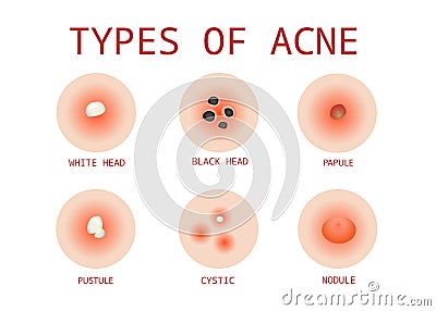 6 Types of Acne, Vector Vector Illustration