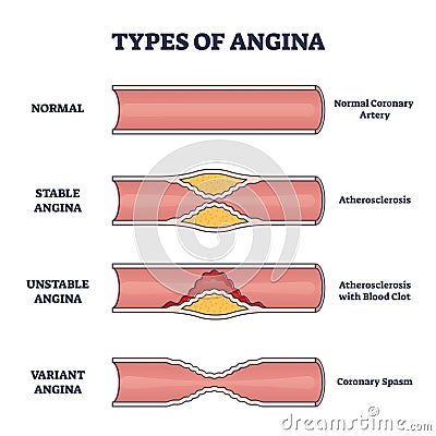 Types of angina as chest pain and heart problem explanation outline diagram Vector Illustration