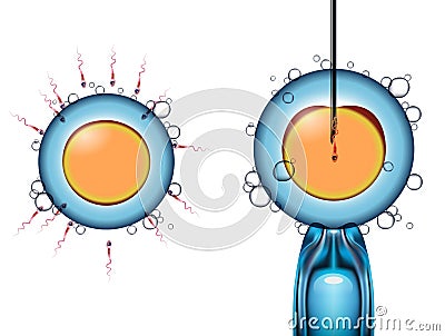 Types of artificial fertilization of the egg by sperm Vector Illustration