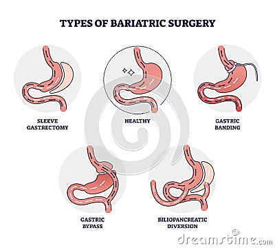 Types of bariatric surgery and stomach reduction control outline diagram Vector Illustration