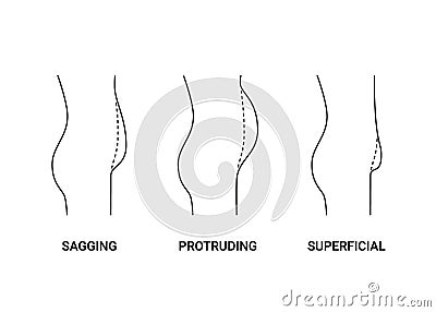 Types bellies of human body, big belly with overweight, line side view. Sagging, protruding and superficial tummy. Loss Vector Illustration