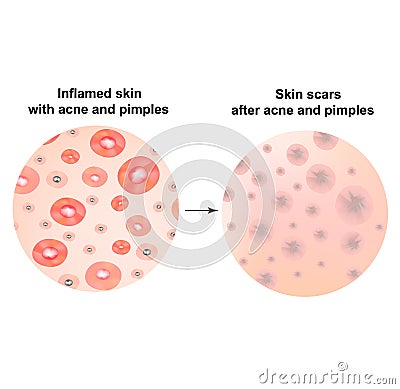 Types of blackheads, pustule, acne. Scarred skin after acne and acne. Infographics. Vector illustration on isolated Vector Illustration