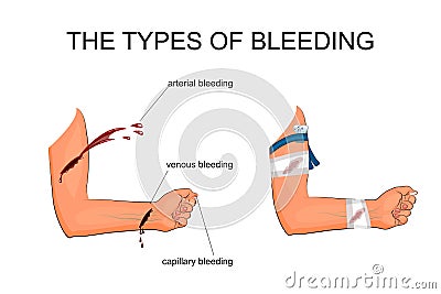 The types of bleeding Vector Illustration