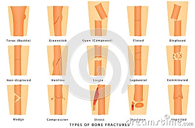 Types of bone fracture Vector Illustration