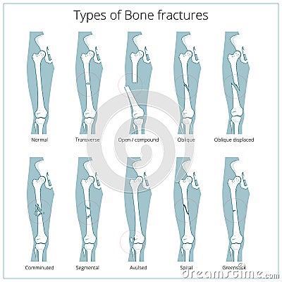 Types of bone fractures medical educational vector Vector Illustration