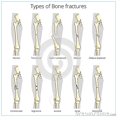 Types of bone fractures medical educational vector Vector Illustration