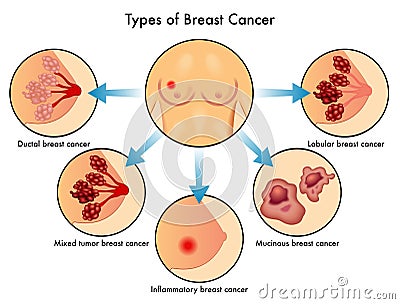 Types of Breast Cancer Vector Illustration