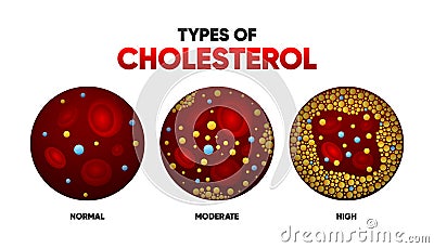 Types Cholesterol in flat style. LDL and HDl level. Arteriosclerosis, infarct, ischemia, thrombosis disease. Cholesterol Vector Illustration