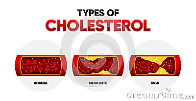 Types Cholesterol. LDL and HDl level. Arteriosclerosis, infarct, ischemia, thrombosis disease. Cholesterol in human Vector Illustration