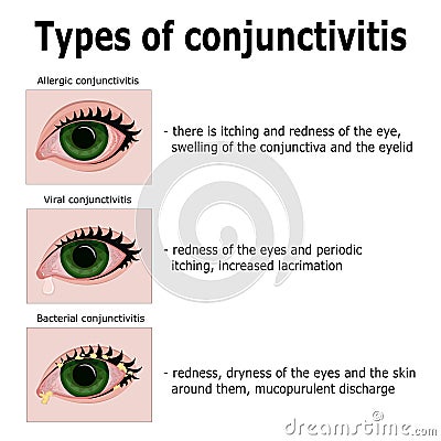 Types of conjunctivitis Vector Illustration