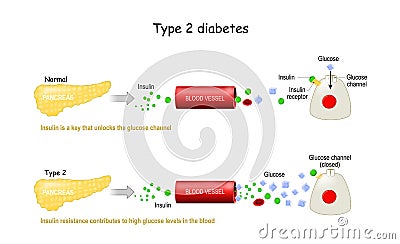 Types 2 of Diabetes Mellitus. Comparison of cell work in diabetes and in a healthy body Vector Illustration