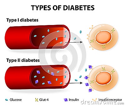 Types of Diabetes Vector Illustration