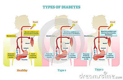 Types of diabetes vector illustration diagram scheme Vector Illustration