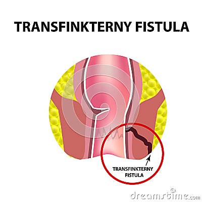 Types of fistulas of the rectum. Paraproctitis. Anus. Abscess of the rectum. Infographics. Vector illustration Vector Illustration