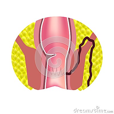 Types of fistulas of the rectum. Paraproctitis. Anus. Abscess of the rectum. Infographics. Vector illustration Vector Illustration