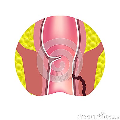 Types of fistulas of the rectum. Paraproctitis. Anus. Abscess of the rectum. Infographics. Vector illustration Vector Illustration