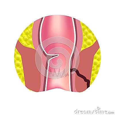 Types of fistulas of the rectum. Paraproctitis. Anus. Abscess of the rectum. Infographics. Vector illustration Vector Illustration