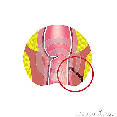 Types of fistulas of the rectum. Paraproctitis. Anus. Abscess of the rectum. Infographics. Vector illustration Vector Illustration