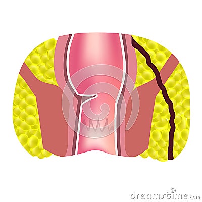 Types of fistulas of the rectum. Paraproctitis. Anus. Abscess of the rectum. Infographics. Vector Vector Illustration